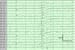 Generalized Epilepsies on EEG