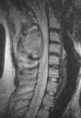 Spinal tumors. MRI of osteoblastoma in posterior e