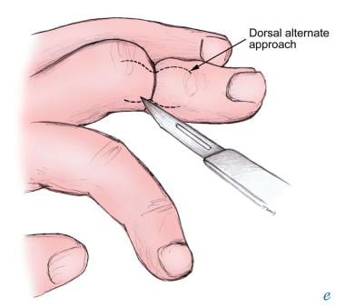 Hair-thread tourniquet syndrome: a case report and review of treatment.