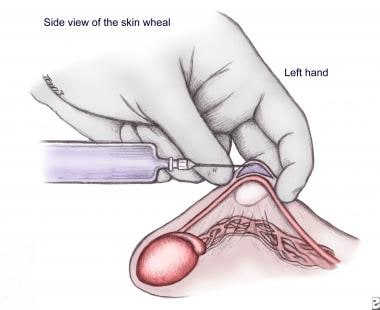 vasectomy stitches