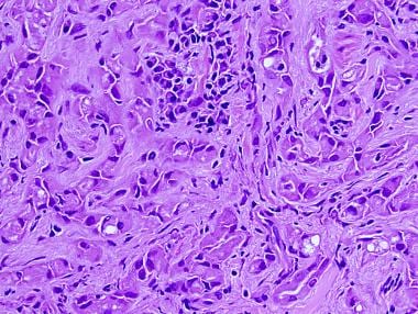 Testicular Adenomatoid Tumor Pathology. Medium mag
