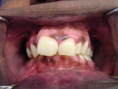 This photograph shows an oral pigmented lesion in 