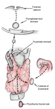 thyroid thyroidectomy embryology technique medscape