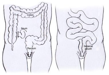 Anatomy of ileal pouch anal anastomosis (IPAA). Patients who