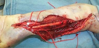 Forearm after compartment release. Median nerve de