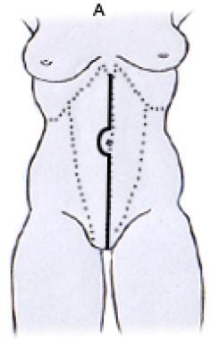 Pain drawings results at 20 (A) and 34 (B) weeks. Percentages indicate