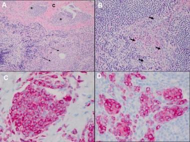 invasive melanoma histology