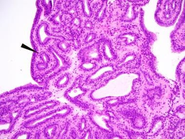 IDP (L/C ST) with a fibrovascular core showing an 