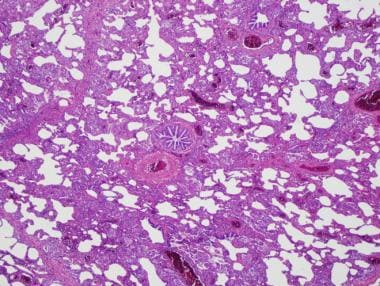A 46-year-old man with hypersensitivity pneumoniti