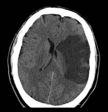 Middle Cerebral Artery Stroke: Overview, Rehabilitation Setting ...