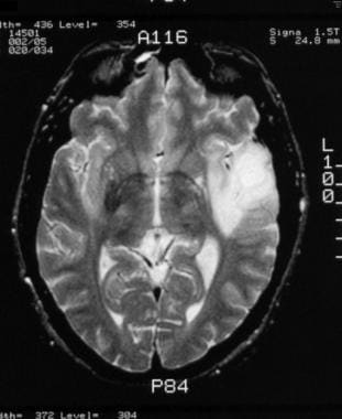 Grade II astrocytoma in a 30-year-old man. Nonenha