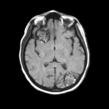 Large, right frontal and left occipital cavernous 
