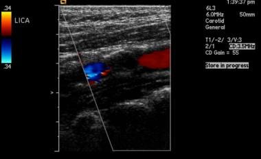 Color Doppler ultrasound of the left internal caro