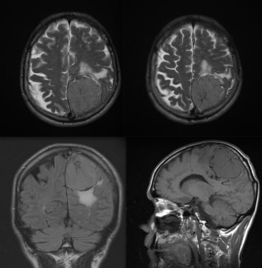 MRI images with the following sequences: axial T2,