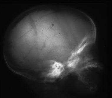 Postmortem radiograph in a child with multiple fra