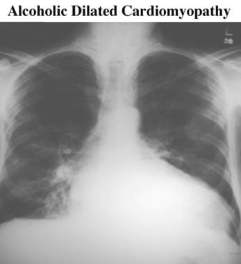 Chest radiograph shows a large heart. Image does n