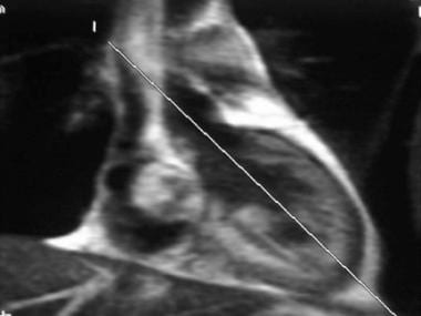 Coronal single-shot fast spin-echo image obtained 