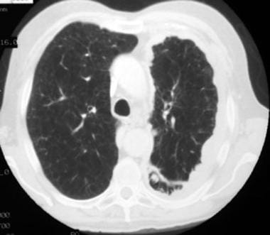 Case 4. The pulmonary window setting of this chest
