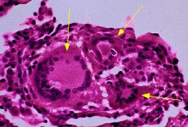 Giant cells are a characteristic feature of hypers