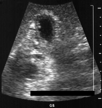 Sonogram in a patient with adenomyomatosis. 