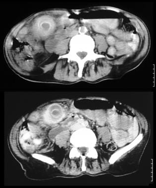 Nonenhanced CT scans through the gallbladder (GB) 