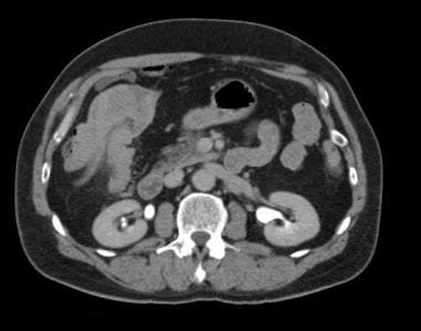 A 62-year-old man with hematuria undergoing excret