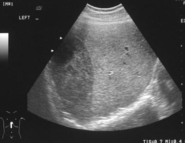 Abdominal sonogram in a 35-year-old male bouncer a