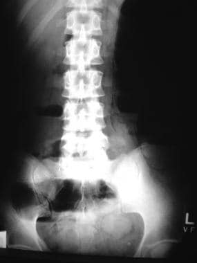 Radiograph in a patient with ischemic bowel demons
