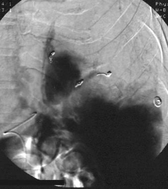 Spleen, trauma. Final arteriographic image from a 