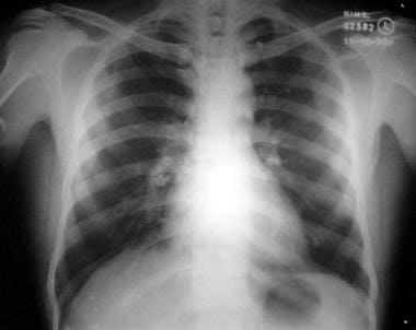 Chest radiograph reveals calcified hilar tuberculo