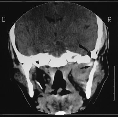 Coronal 5-mm CT cut through the anterior cranial f