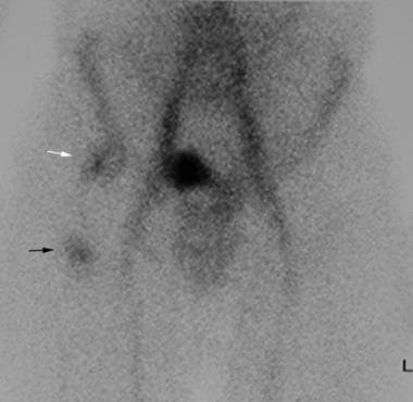 Second-pass, blood pool image demonstrates abnorma