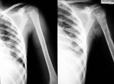 Radiograph of a shoulder in a patient presenting w