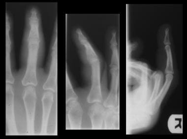 Radiograph views of the fourth finger show diffuse