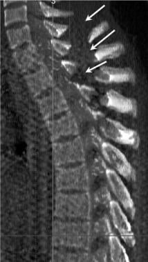 Thoracic spine trauma. Lateral 3-dimensional maxim