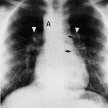 Chest radiograph in a female adolescent with polys