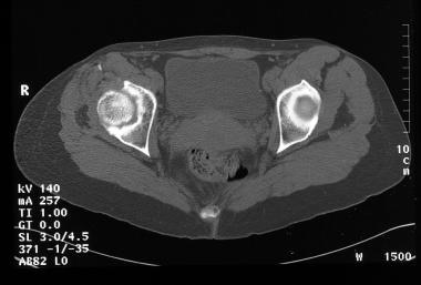 Legg-Calvé-Perthes disease. Nonenhanced axial CT s