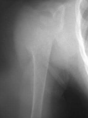 Radiograph of the proximal humerus in a 2.5-year-o