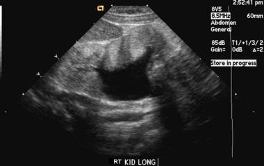 Sonogram of the right kidney in a patient with gra