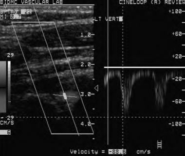 Doppler ultrasound shows reversed flow in the left
