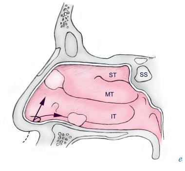 Common sites of impaction of foreign bodies in the