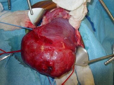 Intraoperative image of a mesenchymal hamartoma. 