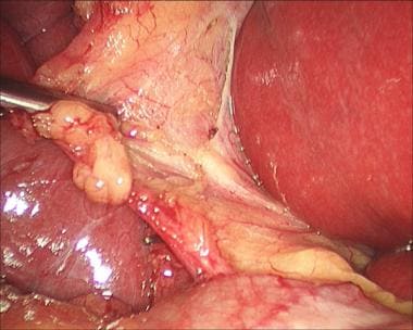 Laparoscopic cholecystectomy. Division of peritone
