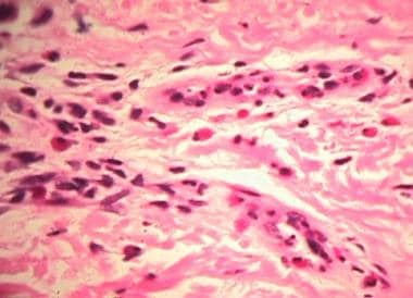 Perivascular mixed inflammatory infiltrate with eo
