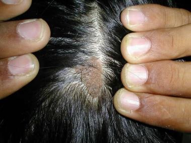 Brownish wartlike plaque in a 25-year-old patient.