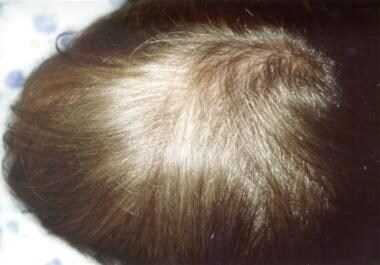 Uncombable hair syndrome