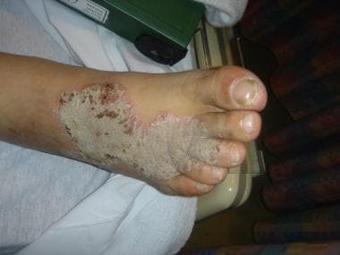 Plaque of necrolytic acral erythema on the ankle o