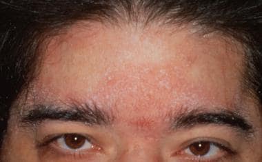Seborrheic dermatitis affecting the scalp line and
