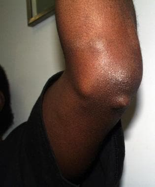 Enchondroma on the left elbow. 