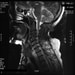 Diagnosis and Management of Cervical Spondylosis